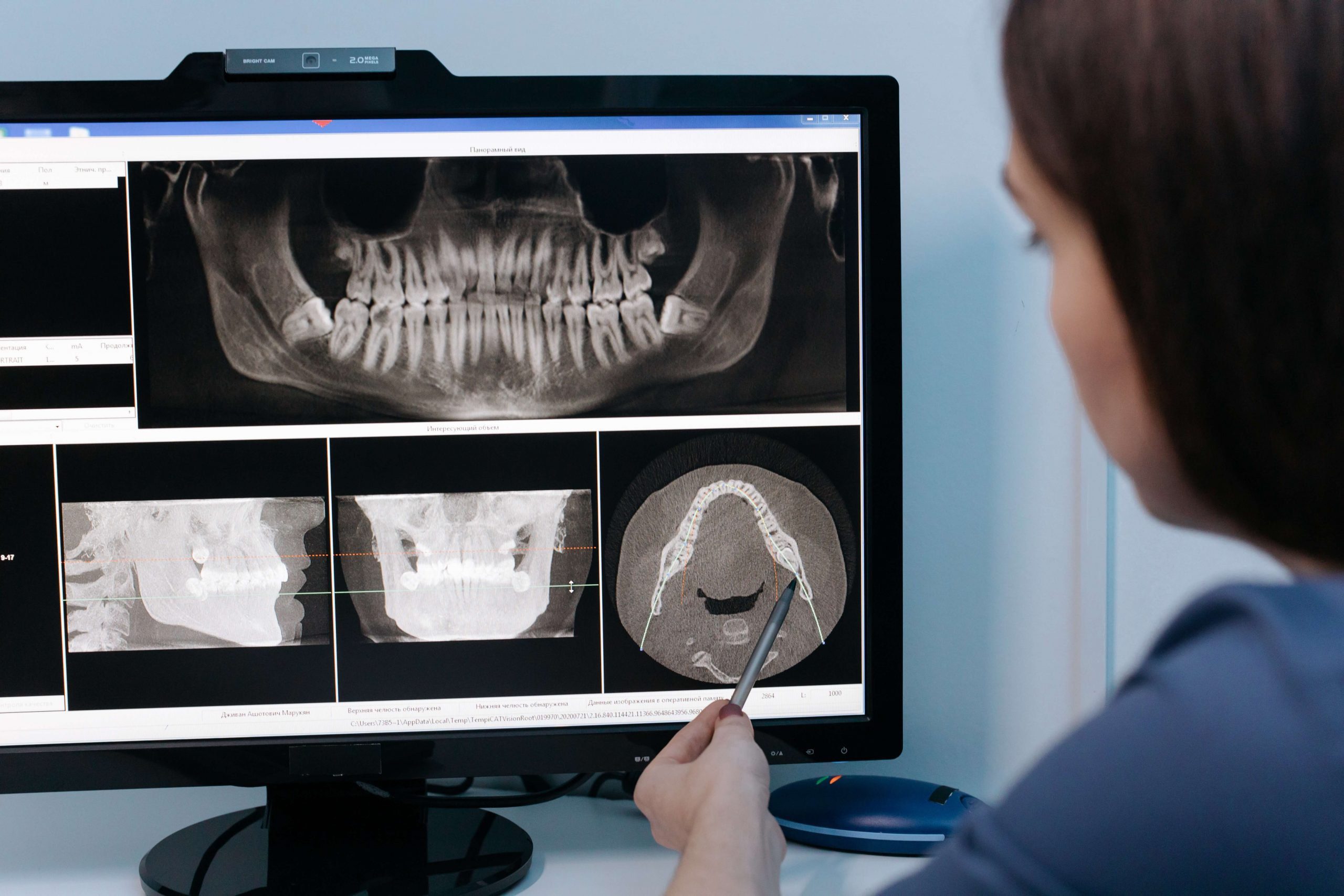 Periapical Xray