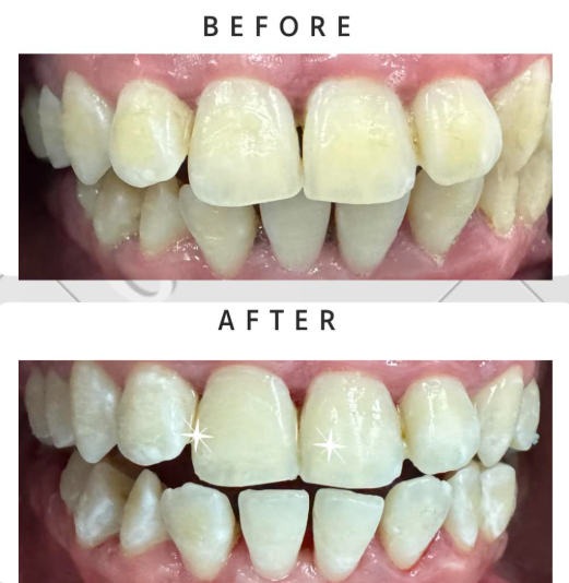 Teeth Whitening